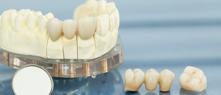 Behandeling kroon of brug J-dental Almere Noorderplassen